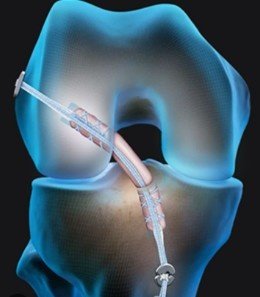 best ACL surgery in Gurgaon