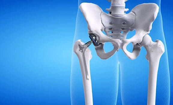 Ortho Hip Replacement in Gurgaon
